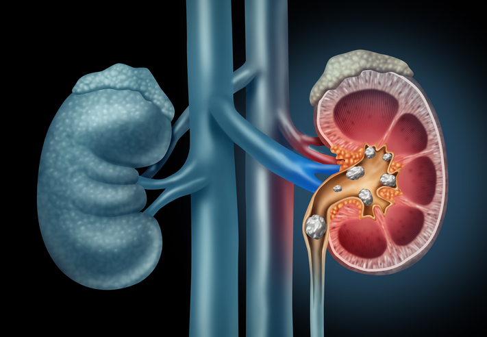 calculo renal